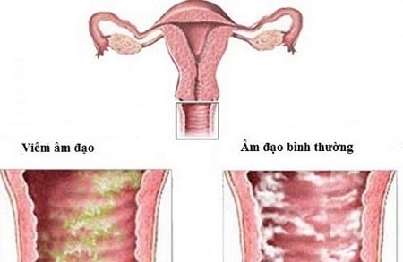 [ Giải đáp ] Bị nấm candida có thai được không ?