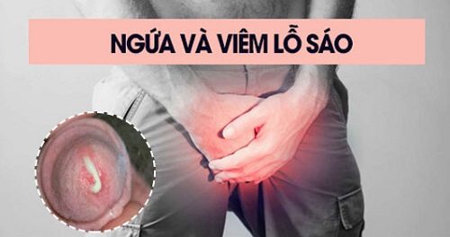 Bị nấm ở bao quy đầu