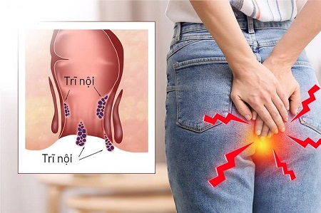 Trĩ nội là gì ? Những ai hay bị trĩ nội ?