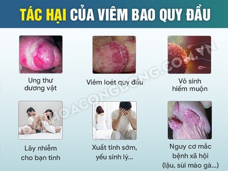 Những biến chứng viêm bao quy đầu nguy hiểm, cần đề phòng