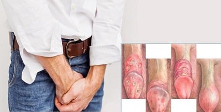 Tìm hiểu thông tin chung về bệnh viêm bao quy đầu là gì ?