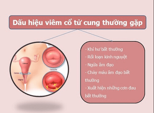 Biểu hiện của bệnh viêm lộ tuyến cổ tử cung