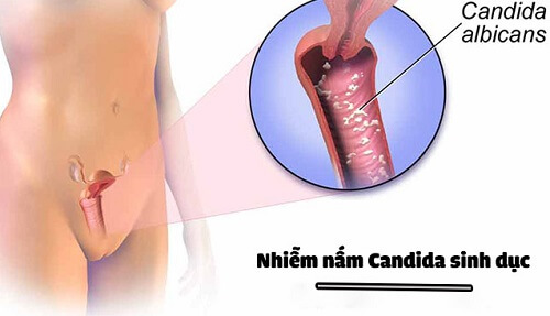 Biểu hiện nấm candida ở nữ giới
