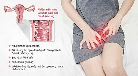 Nhiễm nấm Candida ở nữ giới là gì ?
