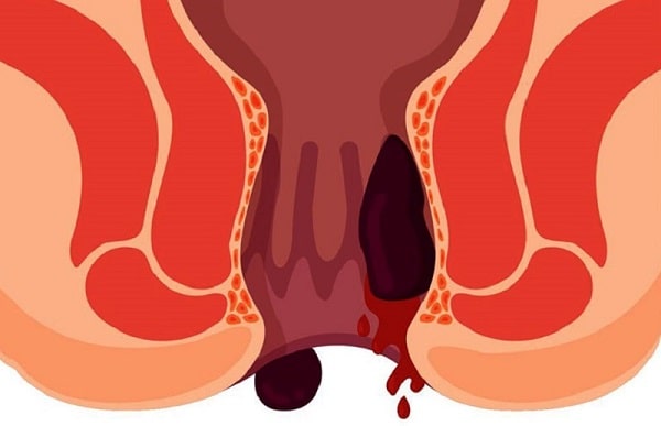 Chảy máu hậu môn do nứt kẽ vì đâu mà xuất hiện?
