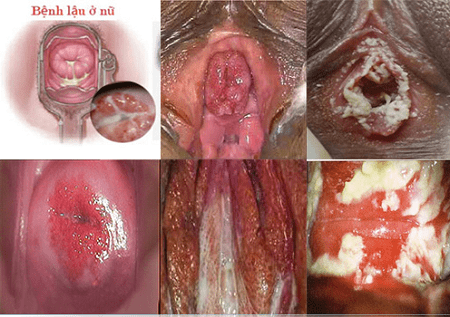 Tìm hiểu bệnh lậu ở nữ và cách chữa trị