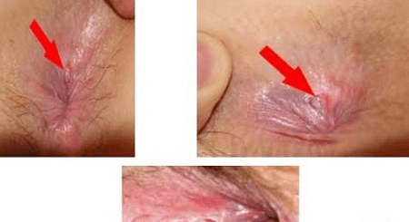 Các phương pháp chữa rò hậu môn tại nhà