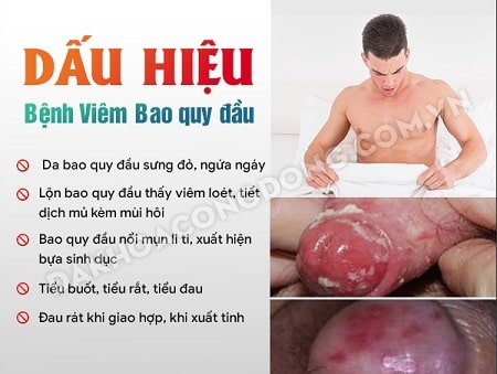Các triệu chứng của viêm bao quy đầu thế nào?