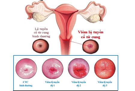 Tổng quan bệnh viêm lộ tuyến cổ tử cung là gì?