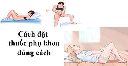 Hướng dẫn cách đặt thuốc viêm phụ khoa hiệu quả
