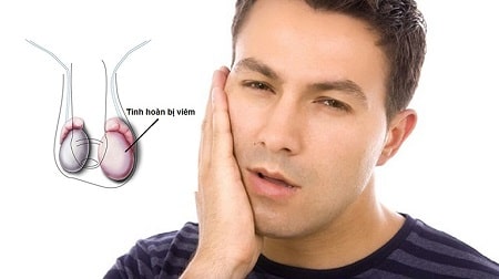 Lý giải nguyên nhân gây viêm tinh hoàn quai bị