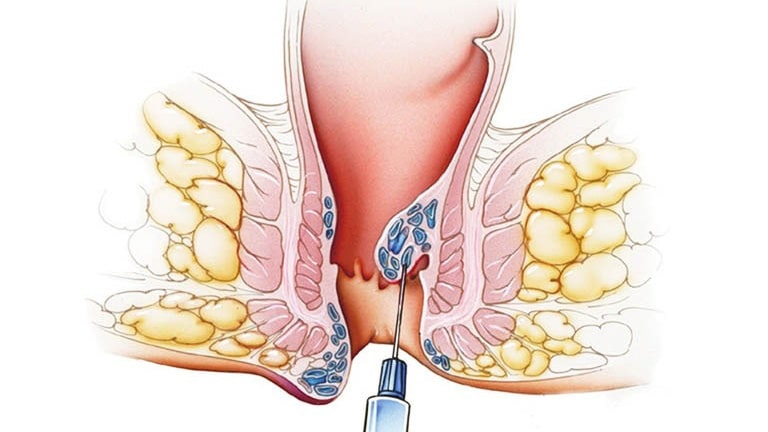 Làm một số thủ thuật hỗ trợ teo búi trĩ