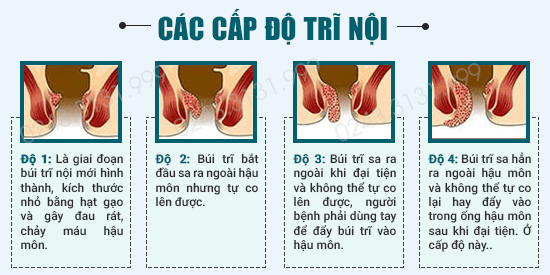 Bệnh trĩ nội là gì và tình trạng sưng búi trĩ qua từng giai đoạn
