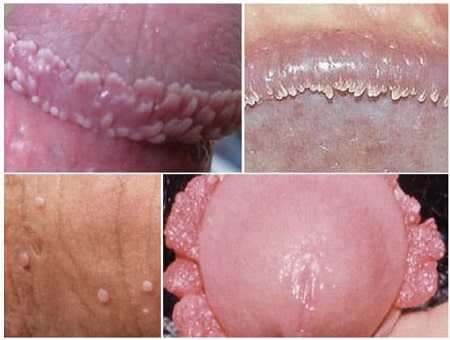 Hình ảnh sùi mào gà như thế nào ? Ghi nhớ để phát hiện kịp thời