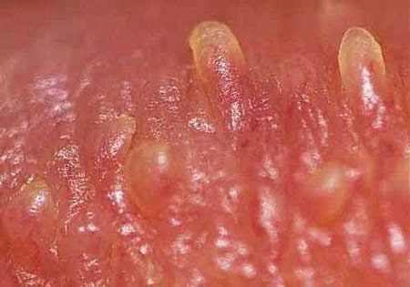 Những cách trị gai sinh dục tại nhà bạn có thể tham khảo