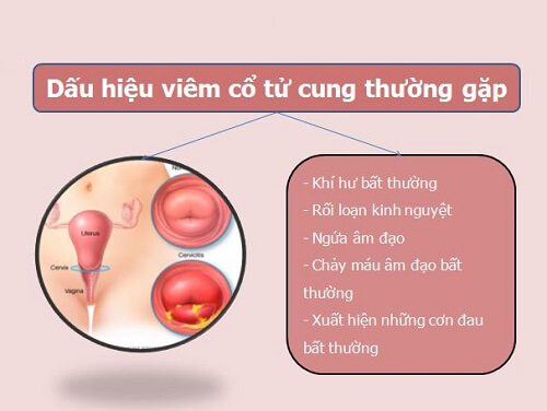 Dấu hiệu viêm cổ tử cung