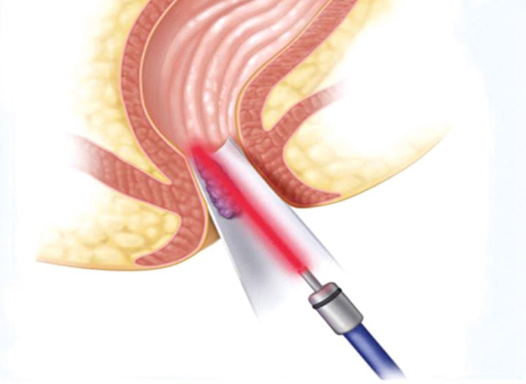 Cắt trĩ bằng phương pháp truyền thống - Laser
