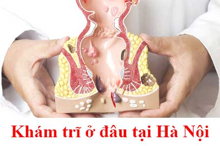 Cắt trĩ ở đâu tốt nhất Hà Nội? Cập nhật 3 địa chỉ uy tín nhất!