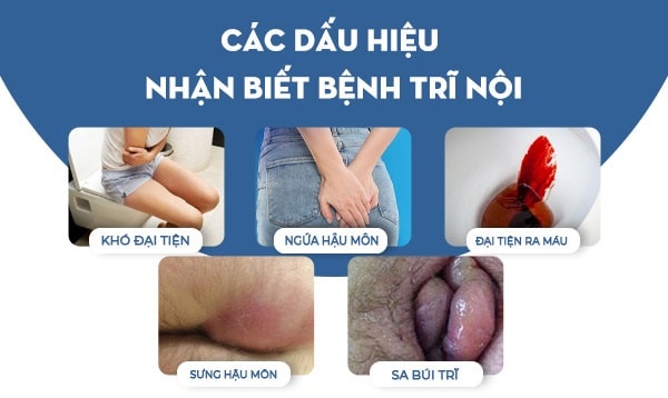 Một vài thông tin cần biết về bệnh trĩ nội 