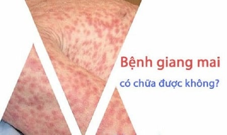 Bệnh giang mai có chữa được không ?