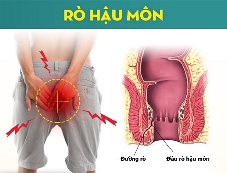 Chi phí phẫu thuật rò hậu môn tốn bao nhiêu tiền