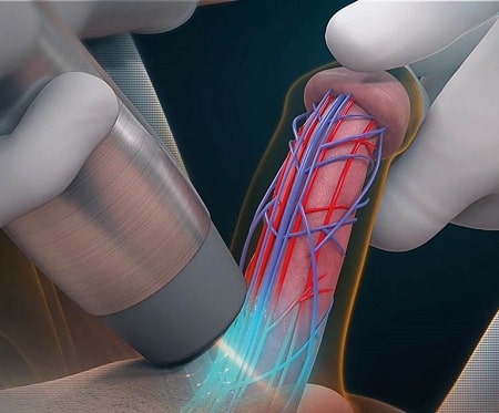 Cách điều trị xuất tinh sớm bằng sóng cao tần an toàn