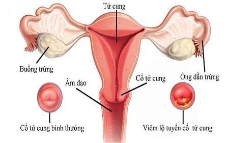 Viêm lộ tuyến ở người chưa quan hệ có nguy hiểm không?
