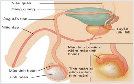 Viêm tinh hoàn là bệnh gì ?