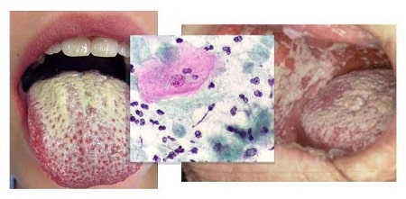 Tổng quan bệnh nấm Candida