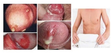 Triệu chứng bệnh lậu ở nam giới