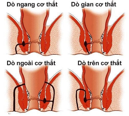 Dấu hiệu rò hậu môn trực tràng