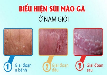 Dấu hiệu sùi mào gà ở nam giúp nhận biết từ sớm