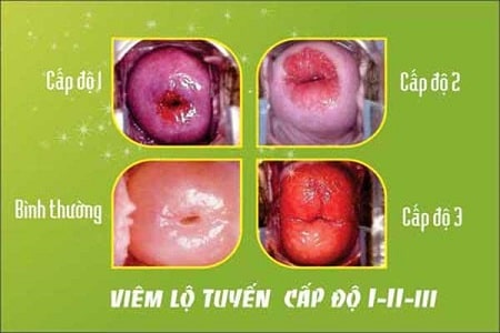 3 cấp độ bệnh viêm lộ tuyến cổ tử cung 
