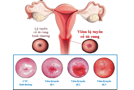 Viêm lộ tuyến cổ tử cung gây ra hậu quả gì ?