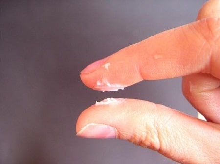  Dấu hiệu bị viêm phụ khoa nặng - Ra nhiều khí hư bất thường