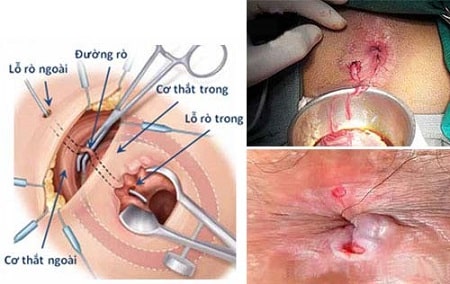Nguyên nhân gây các lỗ rò hậu môn
