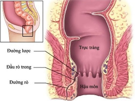 Thông tin về rò hậu môn và cách chữa bằng đông y