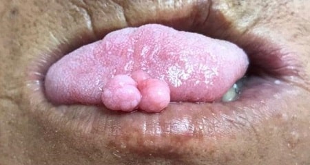 Sùi mào gà ở lưỡi đáng sợ như thế nào?