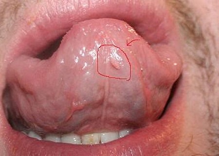 Vì sao sùi mào gà xuất hiện ở lưỡi? Các dấu hiệu nhận biết nhanh chóng