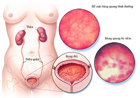Bệnh viêm bàng quang cấp là gì