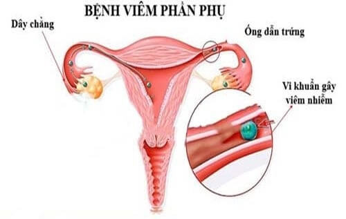 Khí hư vón cục màu xanh- Biểu hiện bệnh viêm phần phụ