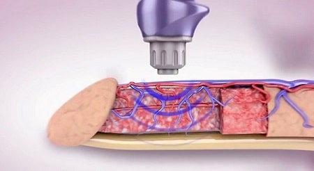 Điều trị xuất tinh sớm bằng sóng xung kích theo cơ chế nào