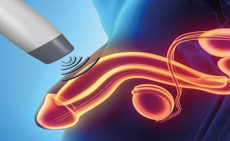 Sóng xung kích điều trị xuất tinh sớm nên hay không?