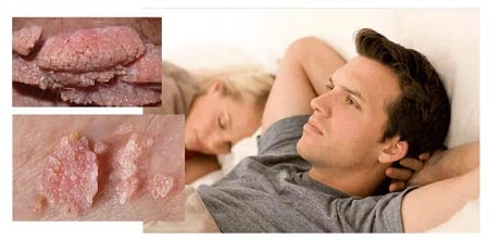 Đốt sùi mào gà sau bao lâu được quan hệ tình dục?