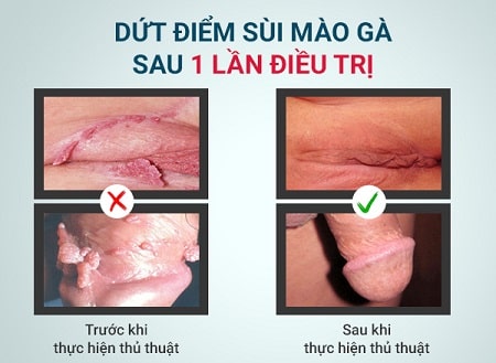 Phương pháp hỗ trợ điều trị bệnh sùi mào gà dứt điểm