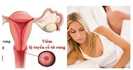 Những việc cần kiêng sau khi đốt viêm lộ tuyến