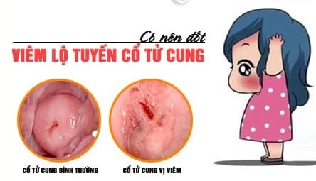 Sau đốt viêm lộ tuyến cổ tử cung bao lâu thì khỏi? 