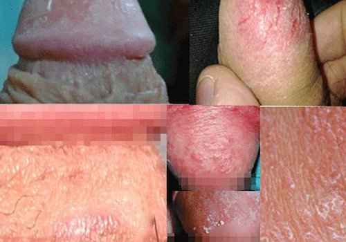 Dương vật bị tróc da 