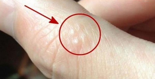 Hình ảnh minh họa dương vật có mụn nước