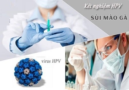 Xét nghiệm sùi mào gà là gì ?